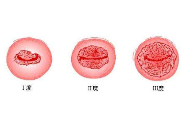 宫颈糜烂是什么?