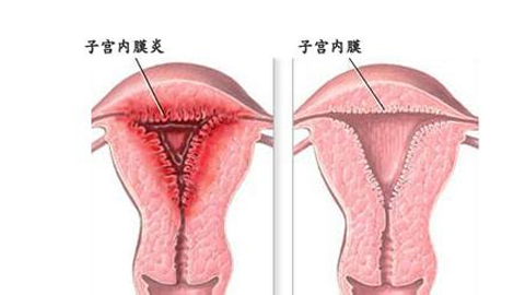 治疗子宫内膜炎需要注意的事项