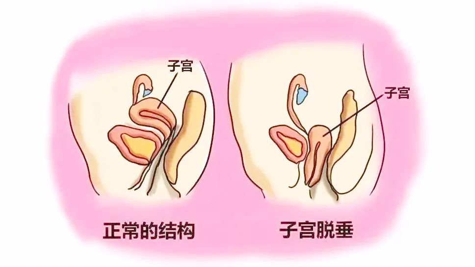 子宫脱垂轻度图片