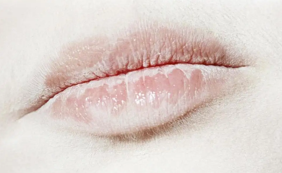 女人嘴唇发白,快来调理体质吧(上)_读文解惑_相关hpv科普知识_盛华