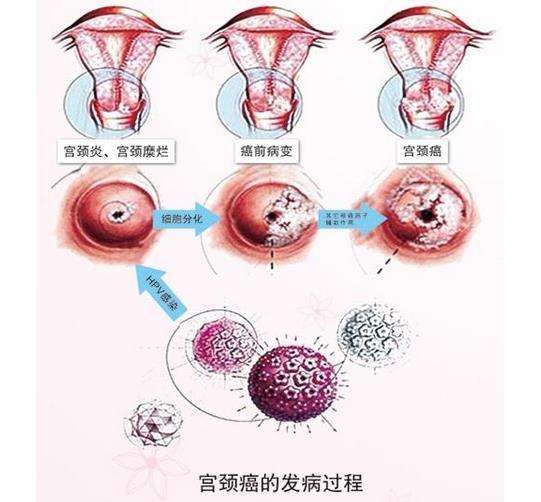 hpv长啥样图片女性图片